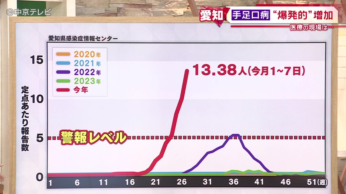 「手足口病」“爆発的”増加　愛知は警報レベルの倍以上　小児医療の現場は…