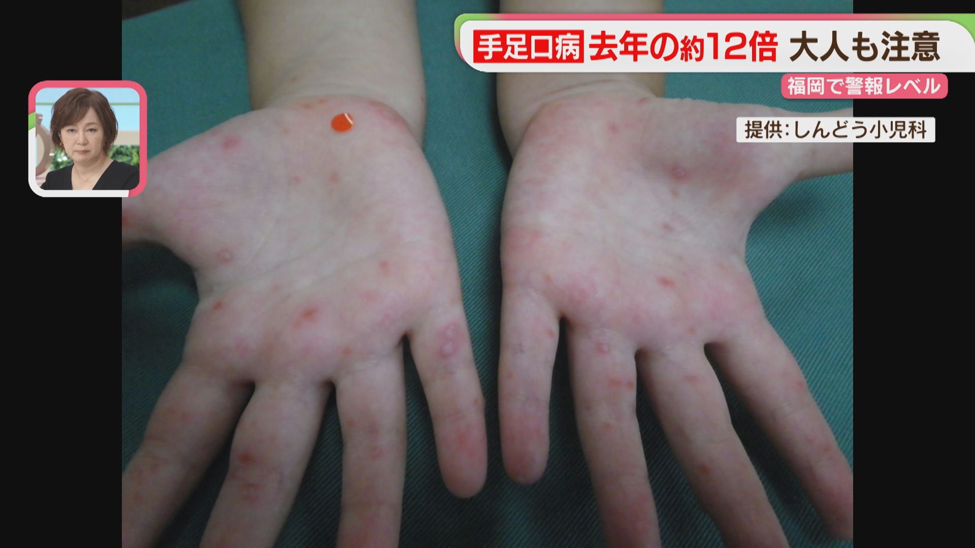 手足口病 福岡で6週連続で警報レベル 大人も注意（2026年7月9日掲載