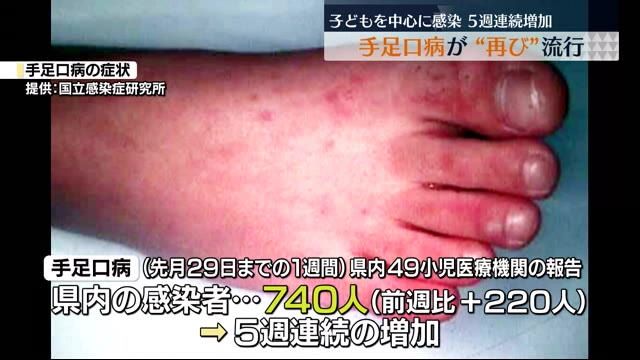 子どもの感染に注意！福島県内で手足口病感染者が5週連続で増加