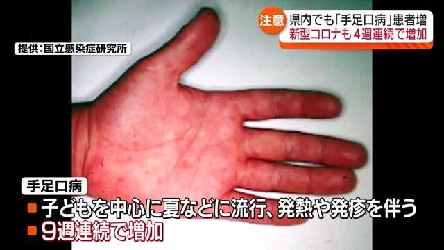 「タオルの共用に注意！」福島県内で手足口病警報発令中　新型コロナも感染拡大