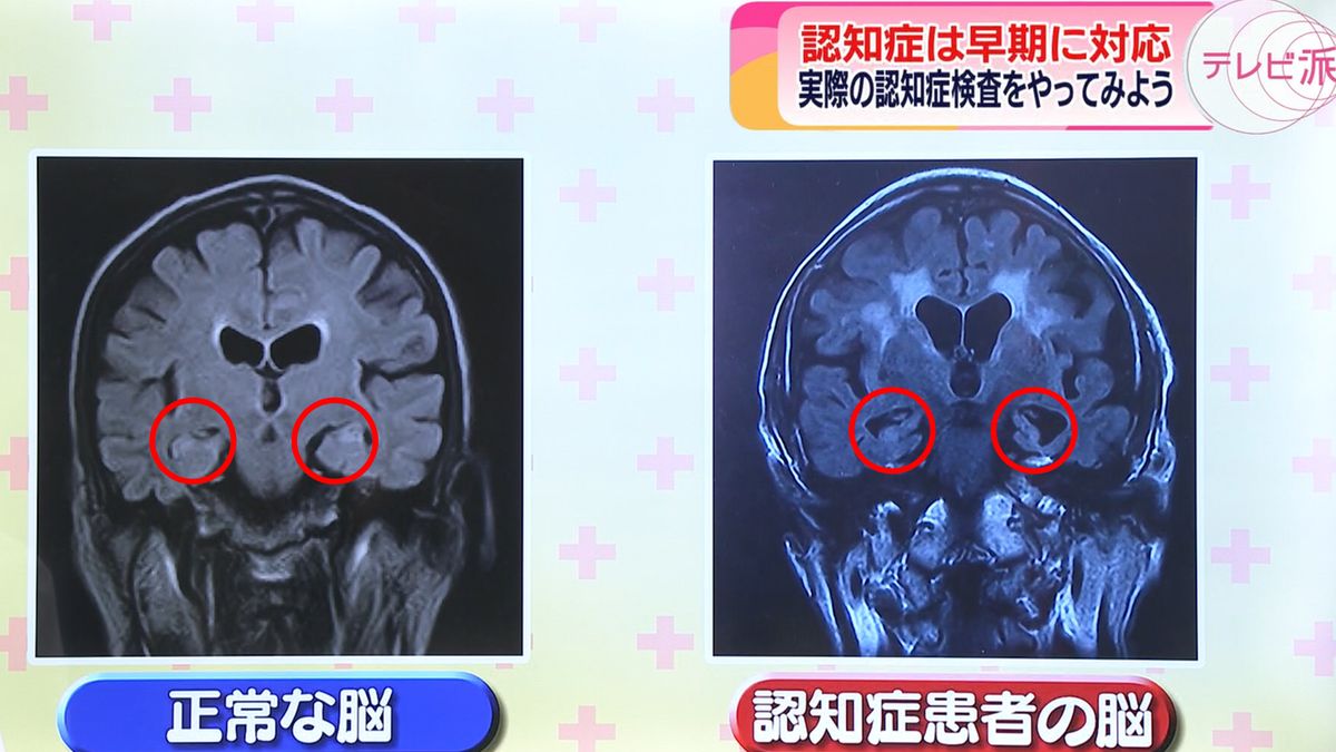 正常な脳の海馬と認知症患者の脳の海馬