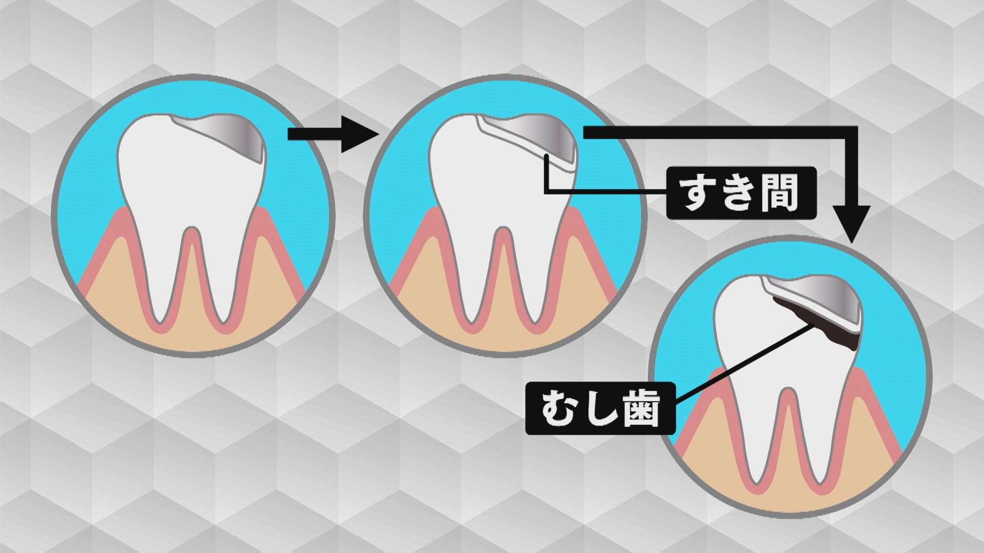 3ページ目 「歯を削らない」最新治療とは 徳島大学発スタートアップが