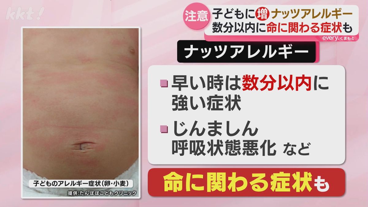 ナッツ アレルギー 治る