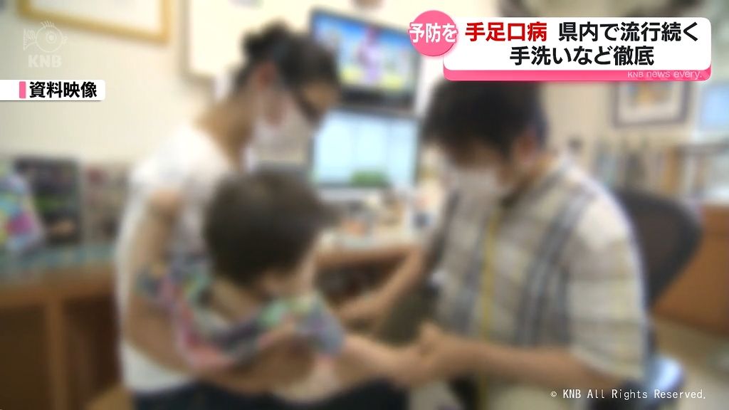 手足口病 富山県内で流行続く 手洗いなど予防徹底を