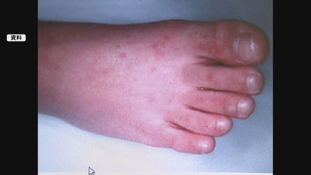鹿児島県内に３年ぶり手足口病の流行発生警報　小さな子どもは特に注意　県が手洗いの徹底を呼びかけ