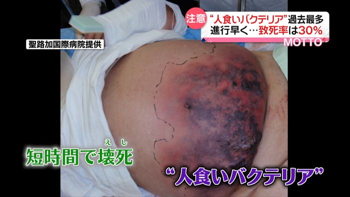 「人食いバクテリア」患者が最多…注意点は