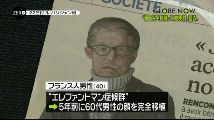 世界初、顔を完全移植 仏男性の夢は…