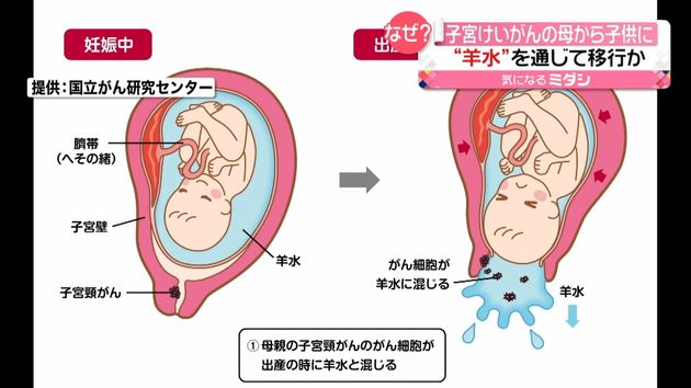 母親のがんが赤ちゃんに 羊水が原因か