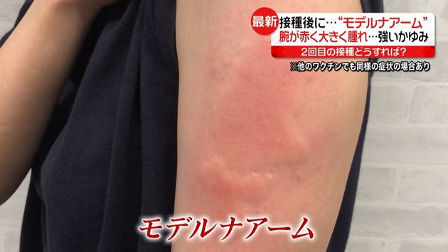 モデルナアーム 腕が腫れ かゆみが