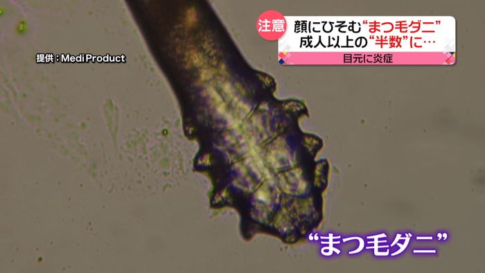 成人の約半数に寄生?“まつ毛ダニ”に注意