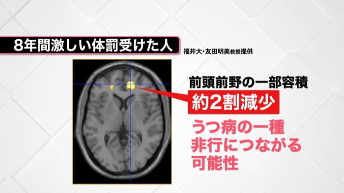 体罰・暴言「愛のむち」で脳が変形する?