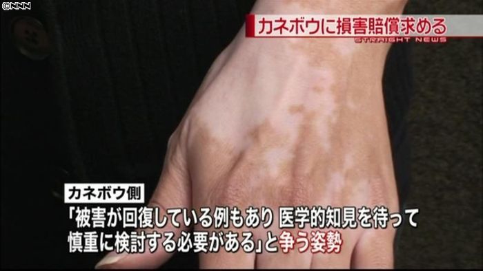 カネボウ、白斑問題で民事訴訟争う姿勢