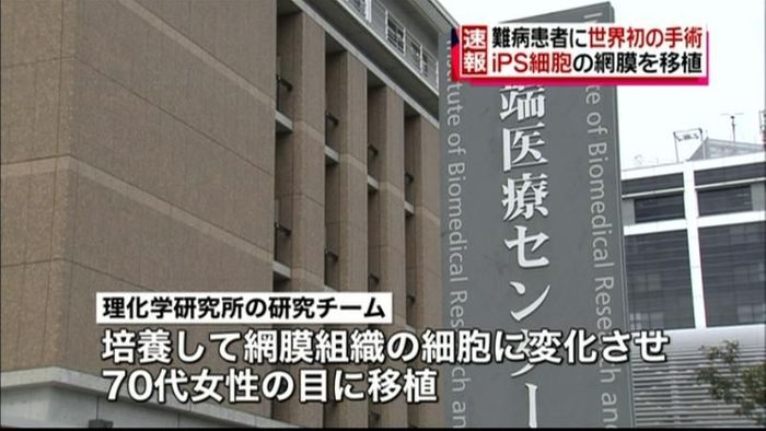 iPS細胞をヒトに応用 世界初の手術終了