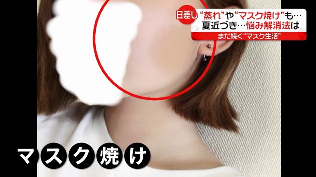 蒸れ や マスク焼け も 解消法は