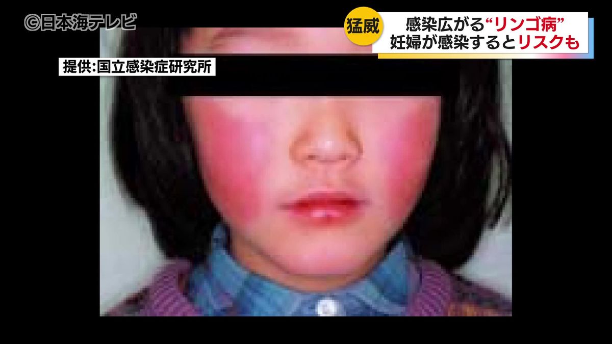 リンゴ病感染が山陰地方で増加中　妊娠中の女性が発症すると流産・早産のリスクも…　感染増加のワケと出来る対策は？　鳥取県鳥取市