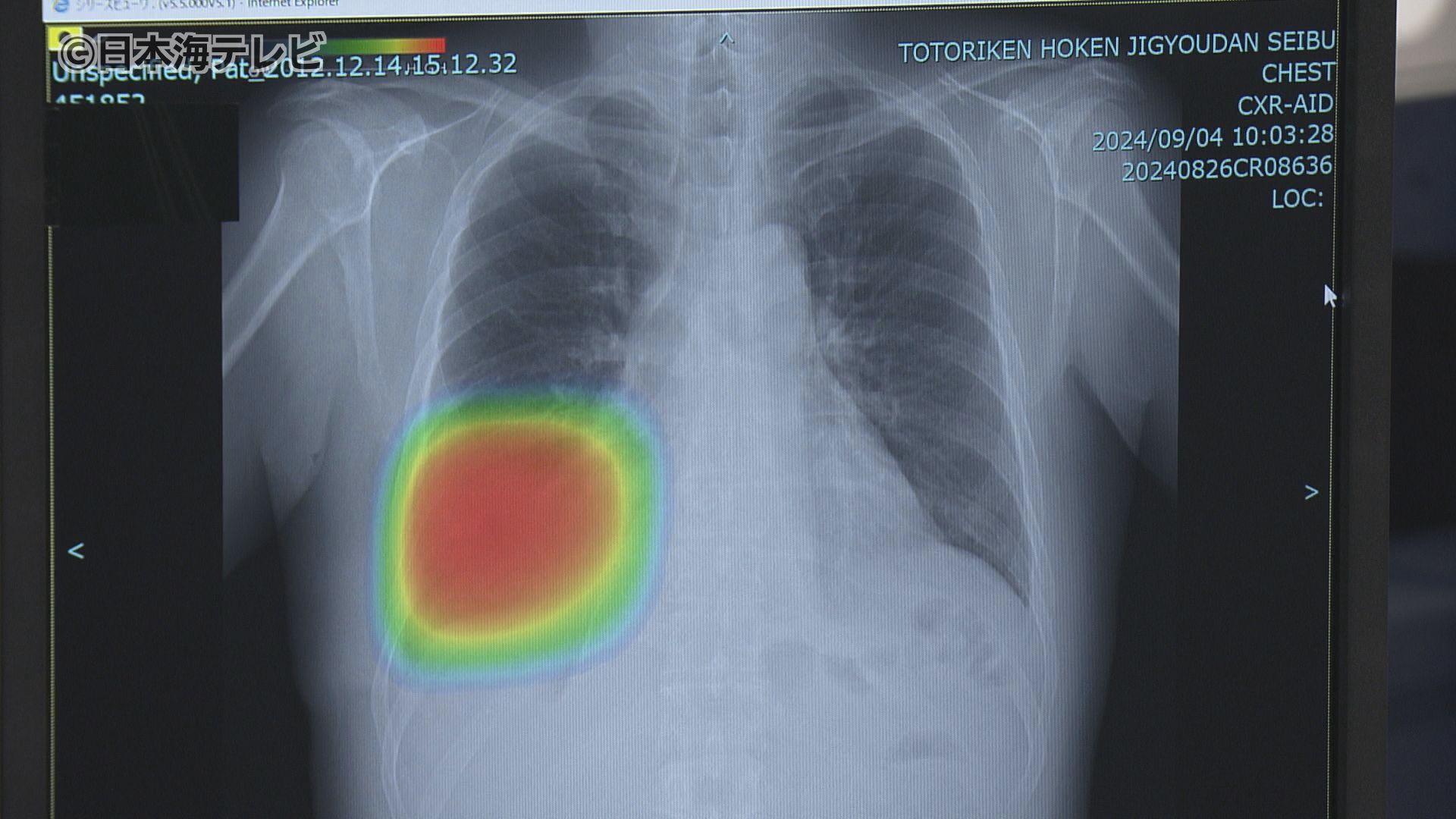 中四国の健診センターで“初” レントゲン検診にAIシステムを導入 医師の負担軽減や診断の効率化へ 鳥取県（2024年12月5日掲載）｜日本海テレビNEWS  NNN