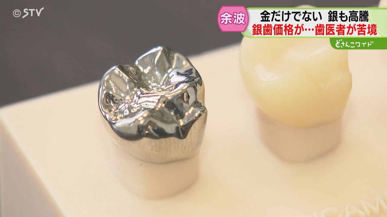 銀価格が3年で4倍に高騰 歯科医院は「赤字になる」銀歯を作れば作る