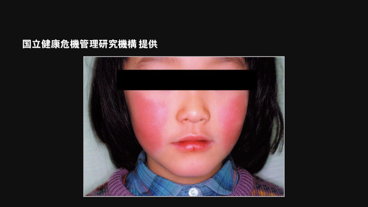 リンゴ病感染広がる　6年ぶりに警報基準超　妊娠中の女性は特に注意必要　大分