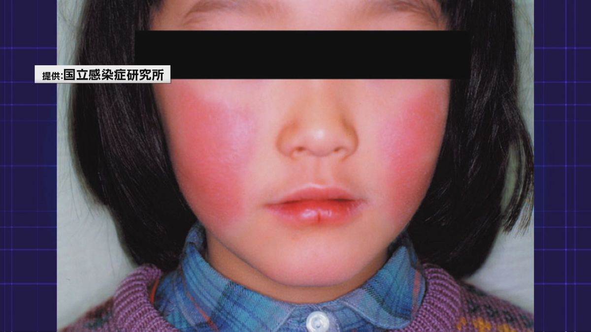 子どもを中心に感染する「伝染性紅班」いわゆる「リンゴ病」が山形県内で6年ぶりに警報レべル