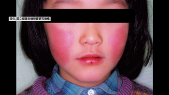 「リンゴ病」新たに峡東保健所管内で警報レベル入り 県内患者は8週連続で増加 山梨