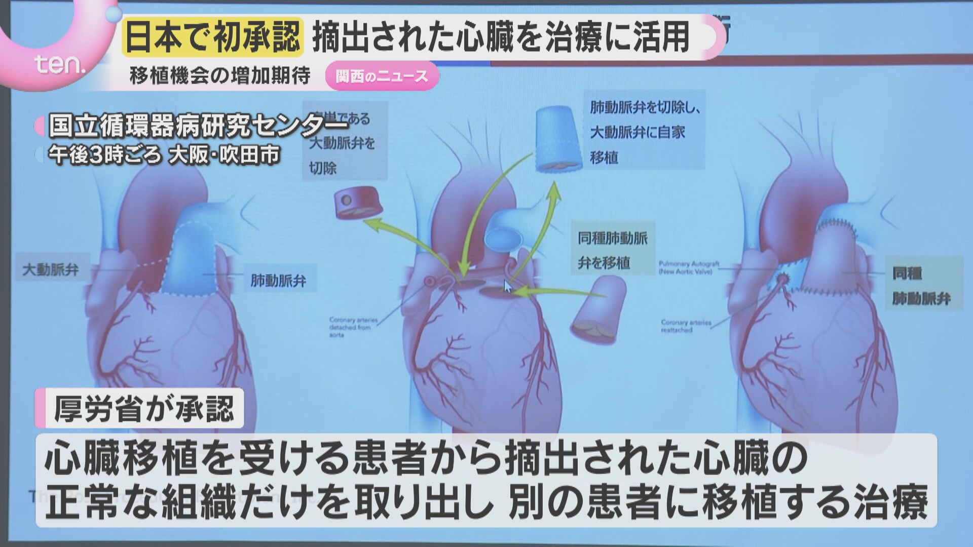 摘出した心臓の”正常組織”別の患者に再移植 国内初の承認 国立循環器病