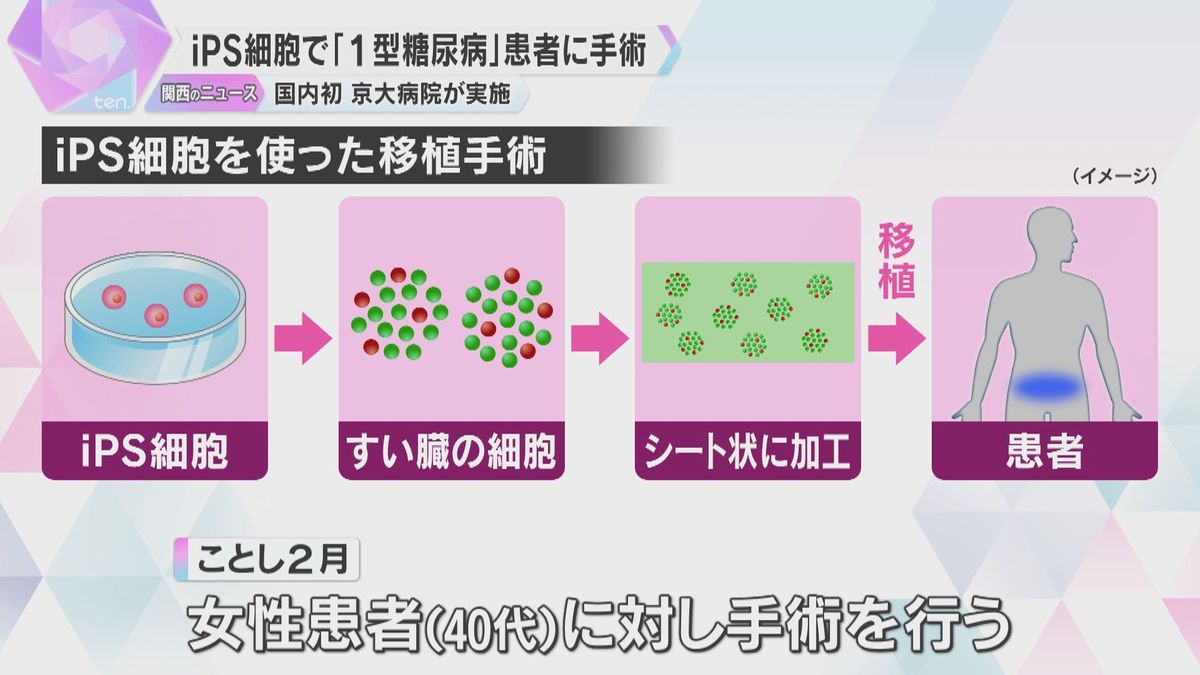 「糖尿病を治る病気に」国内初のiPS細胞で患者に移植手術　2030年代の実用化を目指す　京大病院