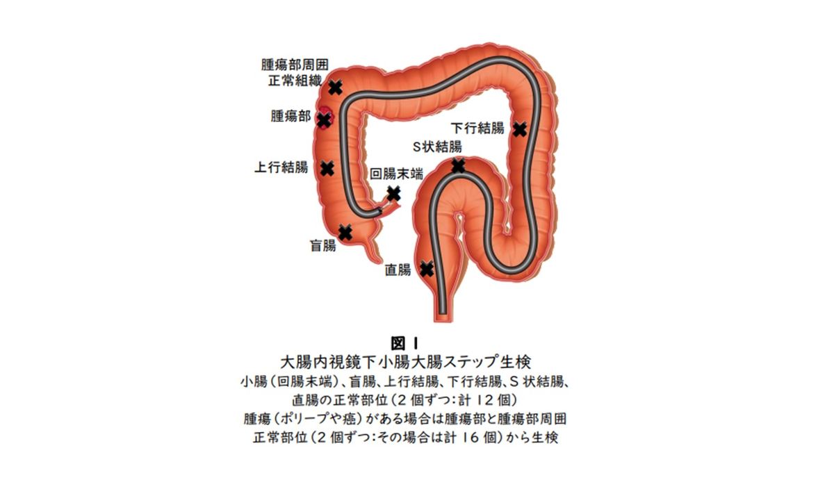 【速報】大阪大学など新発見　大腸は右と左で異なる役割　小腸は免疫の中枢担う　大腸がん新治療に期待