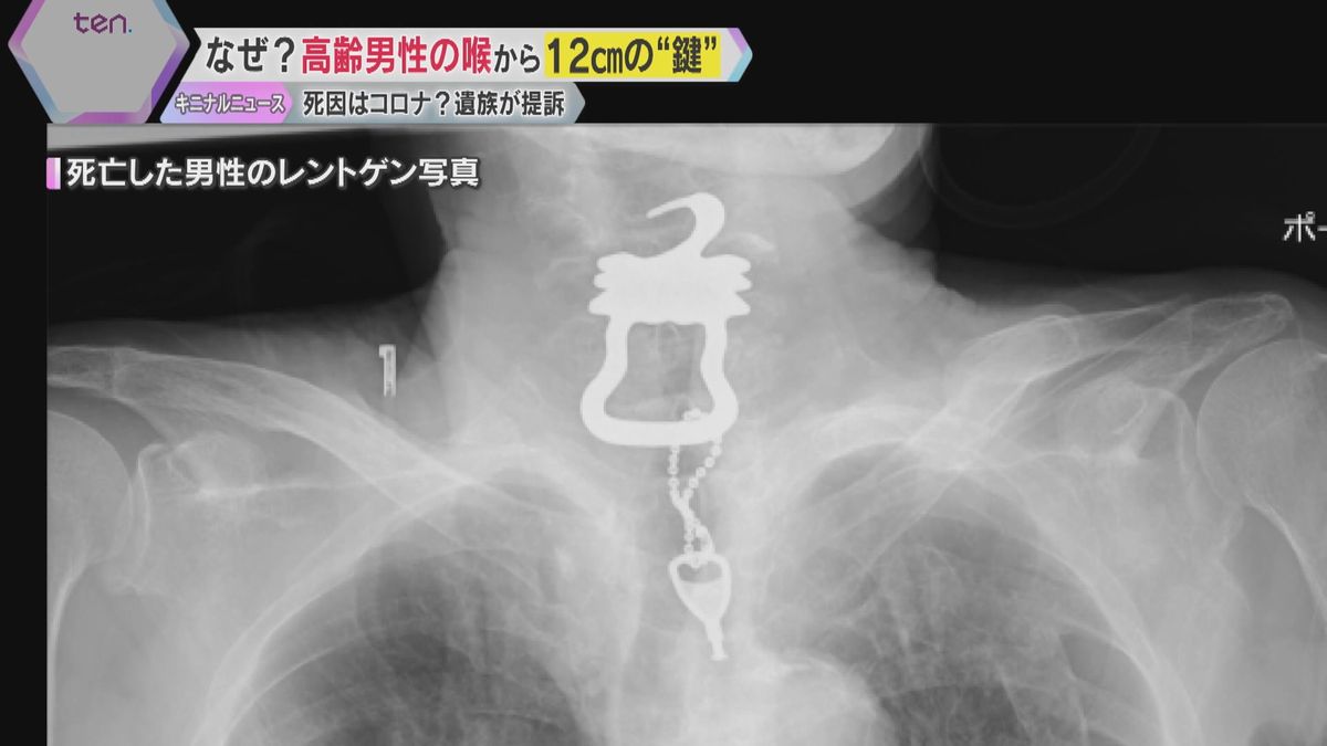 高齢男性の喉から12センチの「鍵」 死因はコロナ？遺族が提訴　病院側は誤飲と死亡の因果関係認めず